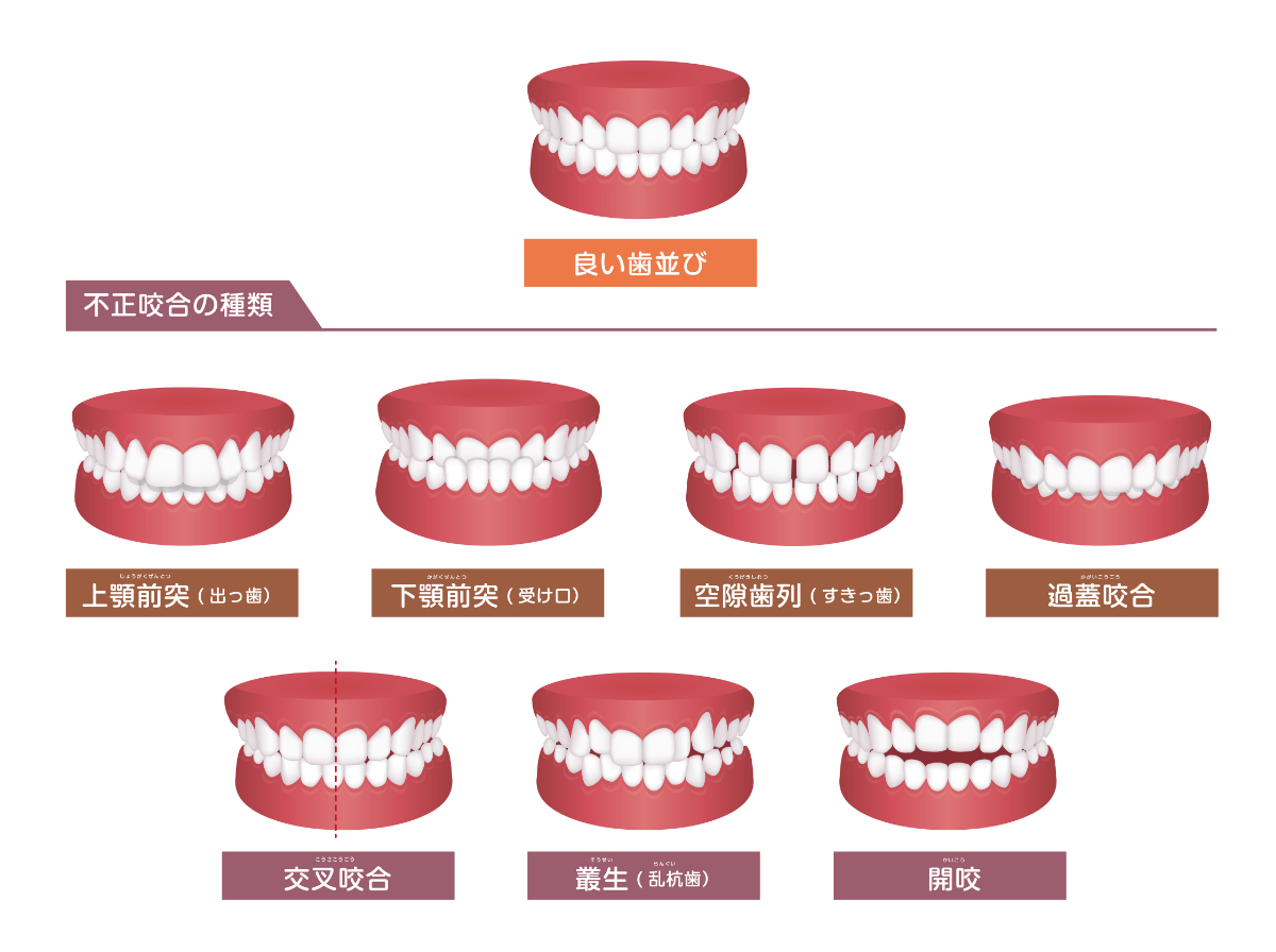 不正咬合の7種類