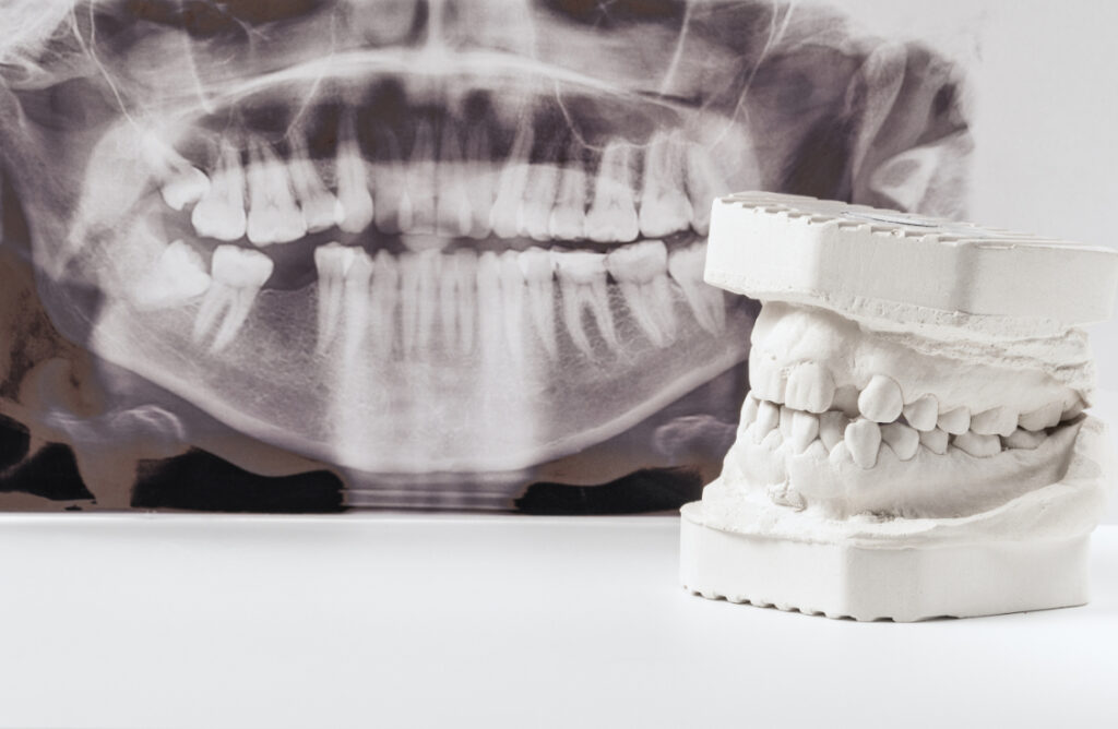 歯のレントゲン写真と模型